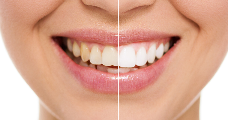 A close-up of a smile showing before and after cosmetic dentistry